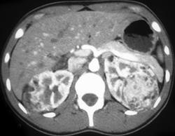 Renal Cell Carcinoma in Patient With Von Hippel-Lindau syndrome (VHL) - CTisus CT Scan