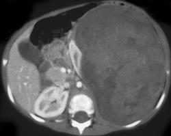 Wilms Tumor - CTisus CT Scan