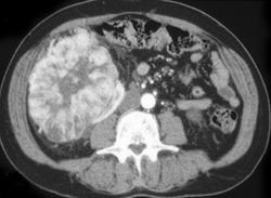 Oncocytoma - CTisus CT Scan