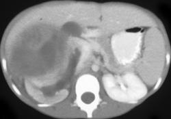 Wilms Tumor - CTisus CT Scan