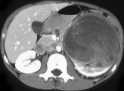 Wilms Tumor - CTisus CT Scan