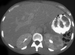 Acute Pyelonephritis - CTisus CT Scan