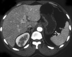 Acute Pyelonephritis - CTisus CT Scan