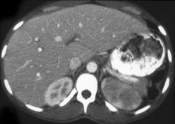 Acute Pyelonephritis - CTisus CT Scan