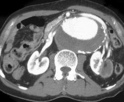 Renal Infarct Secondary to Aortic Aneurysm - CTisus CT Scan