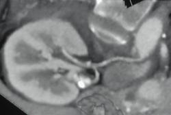 Renal Artery Aneurysm - CTisus CT Scan