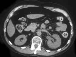 Stone Just Passed From Left Ureter - CTisus CT Scan