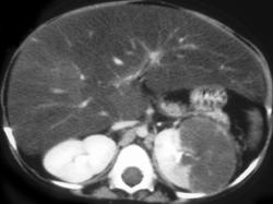 Acute Pyelonephritis (looks Like Infarct) - CTisus CT Scan