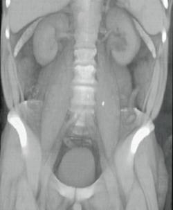 Stone in Mid Third of Left Ureter - CTisus CT Scan