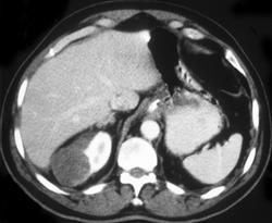 Renal Carcinoma Presents With Bleed - CTisus CT Scan