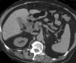 Aortic Dissection Presented as Suspected Renal Colic - CTisus CT Scan