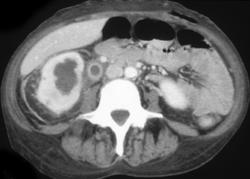 Obstructed Right Kidney Due to Distal Calculus - CTisus CT Scan