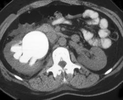 Distal Right Ureteral Calculus - CTisus CT Scan