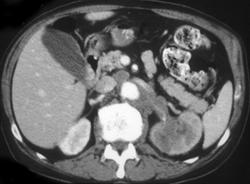 Transitional Cell Carcinoma - CTisus CT Scan