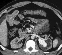 Av Fistulae - CTisus CT Scan