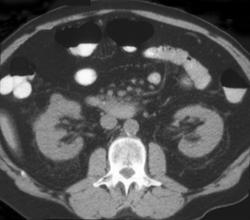 1 Cm Renal Cell Carcinoma - CTisus CT Scan