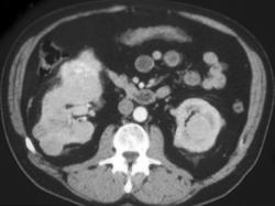 Multiple Right and Left Renal Cell Carcinomas - CTisus CT Scan