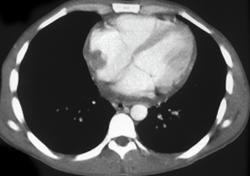 Lymphoma Involving Kidney and Heart - CTisus CT Scan