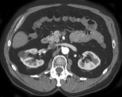 Renal Cyst - CTisus CT Scan