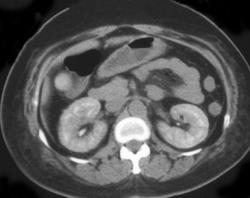 Acute tubular necrosis (ATN) - CTisus CT Scan