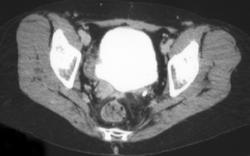 Transitional Cell Carcinoma of the Distal Ureter - CTisus CT Scan