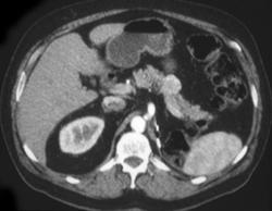 Post Left Nephrectomy With Metastases to the Pancreas - CTisus CT Scan