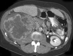 Hypervascular Renal Cell Carcinoma - CTisus CT Scan