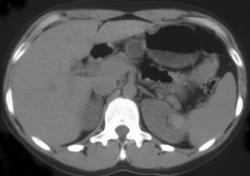 High Density Renal Cyst - CTisus CT Scan