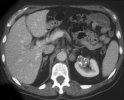 Calcified Renal Cell Carcinoma - CTisus CT Scan