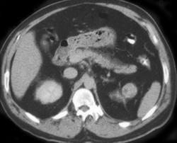 Incidental Renal Cell Carcinoma (lt) in Trauma Patient - CTisus CT Scan