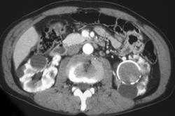 Renal Carcinoma in Polycystic Kidney - CTisus CT Scan