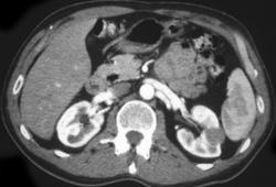 Cystic Renal Cell Carcinoma - CTisus CT Scan