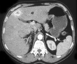 Hypervascular Liver Metastases From Renal Cell Carcinoma - CTisus CT Scan