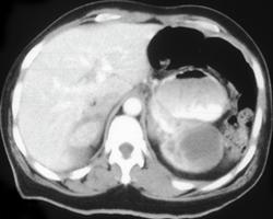 Renal Abscess in Leukemia Patient - CTisus CT Scan