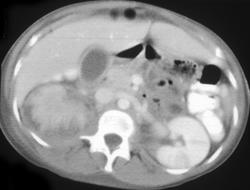 Renal Abscess - CTisus CT Scan