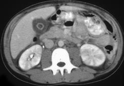 Striated Nephrogram-pyelonephritis - CTisus CT Scan