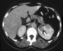 Acute Pyelonephritis - CTisus CT Scan