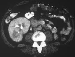 Acute Pyelonephritis With A Focal Abscess - CTisus CT Scan