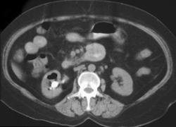 Emphysematous Pyelitis Due to Ascending Infection - CTisus CT Scan