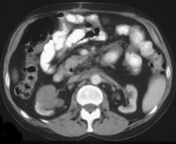 Renal Lymphoma - CTisus CT Scan