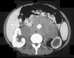 Renal Lymphoma - CTisus CT Scan