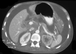 Renal Lymphoma - CTisus CT Scan