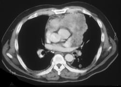 Renal Lymphoma - CTisus CT Scan