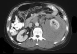 Renal Lymphoma - CTisus CT Scan