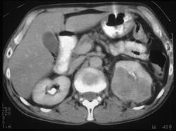 Renal Lymphoma - CTisus CT Scan