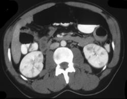 Bilateral Renal Lymphoma - CTisus CT Scan