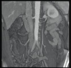 2 Left Renal Arteries - CTisus CT Scan