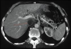 Renal Cell Cancer Invades Renal Vein and IVC - CTisus CT Scan