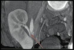 Normal Renal Transplant - CTisus CT Scan