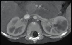 Cystic Renal Cell Carcinoma - CTisus CT Scan